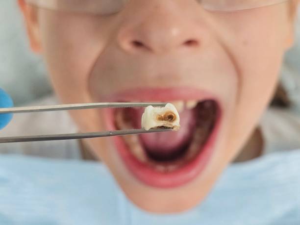 Best Emergency Dental Extractions in Avondale Estates, GA